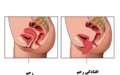 افتادگی رحم