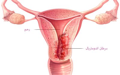 از علائم سرطان رحم تا درمان!