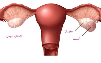 علائم کیست تخمدان