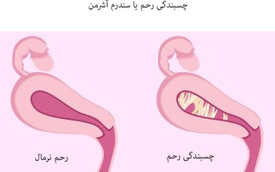 چسبندگی رحم