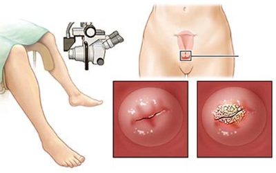 کولپوسکوپی چیست؟