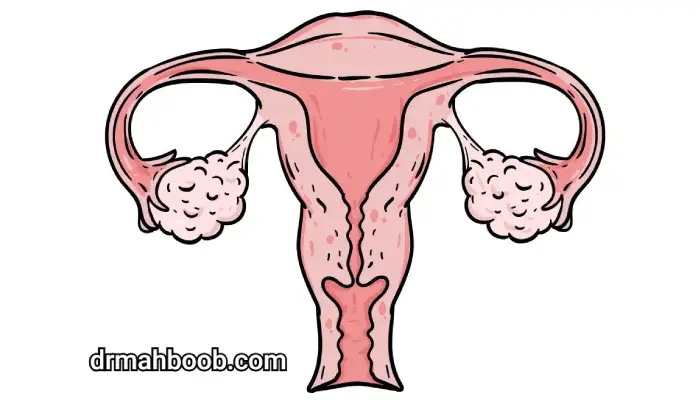 تنبلی تخمدان