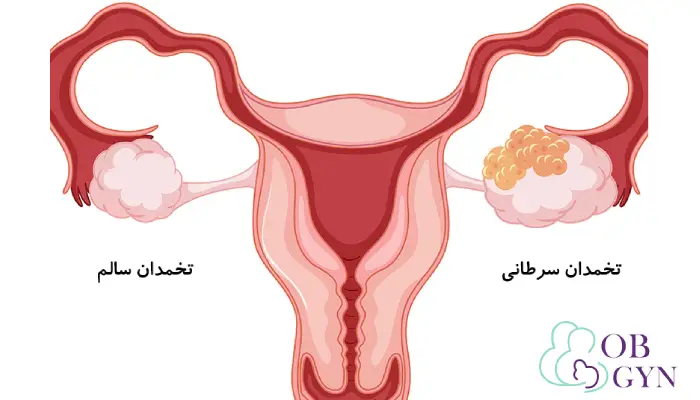 سرطان تخمدان