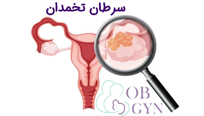 سرطان تخمدان