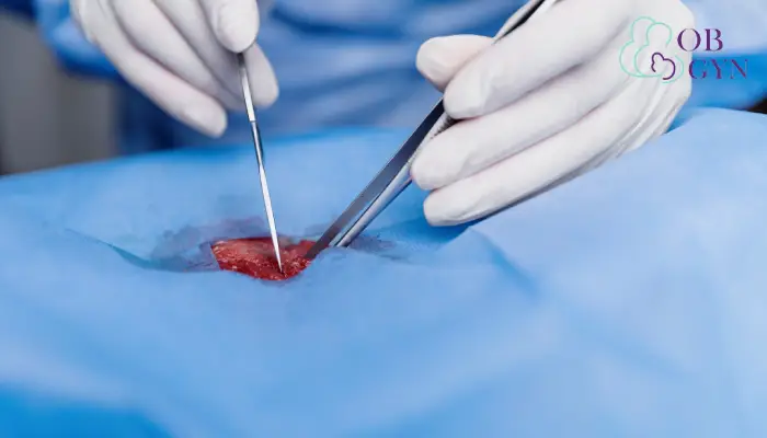 جراحی کیست تخمدان